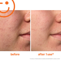 Thumbnail for Kate Somerville ExfoliKate Intensive Exfoliating Treatment